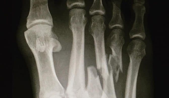 Gãy xương bàn chân - Hình ảnh minh họa